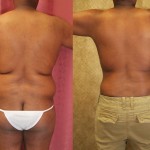 Male Liposuction Abdomen Before & After Patient #5675