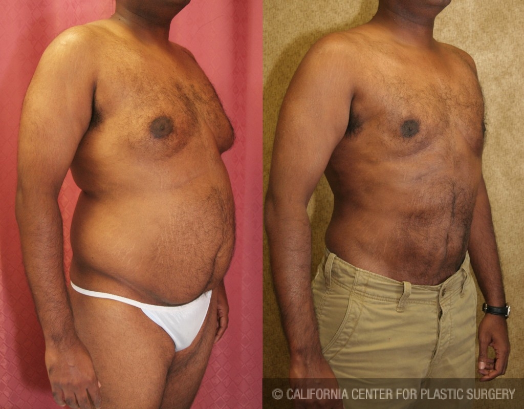 Male Liposuction Abdomen Before & After Patient #5675