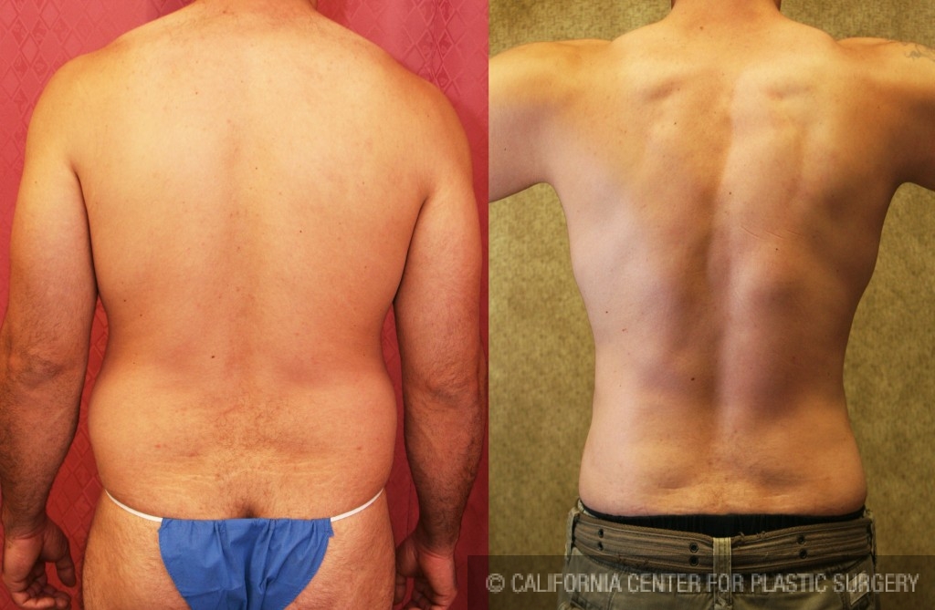 Male Liposuction Abdomen Before & After Patient #5680