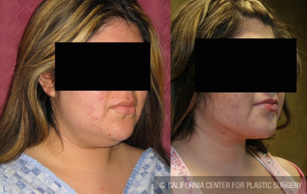 Neck & Face Liposuction Before & After Patient #6654