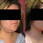 Neck & Face Liposuction Before & After Patient #6654