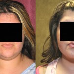 Neck & Face Liposuction Before & After Patient #6654