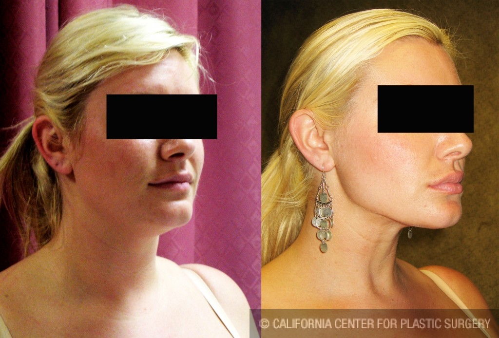 Neck & Face Liposuction Before & After Patient #6609