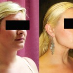Neck & Face Liposuction Before & After Patient #6609