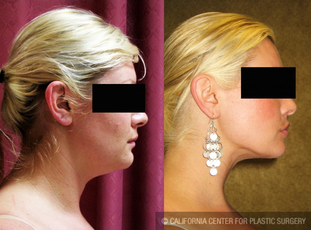 Neck & Face Liposuction Before & After Patient #6609