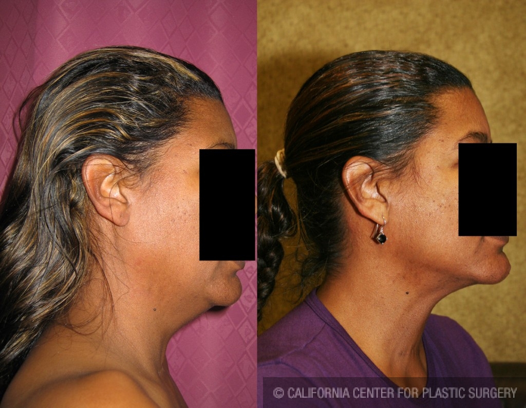 Neck & Face Liposuction Before & After Patient #6659