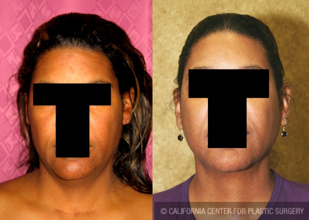 Neck & Face Liposuction Before & After Patient #6659