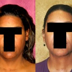 Neck & Face Liposuction Before & After Patient #6659