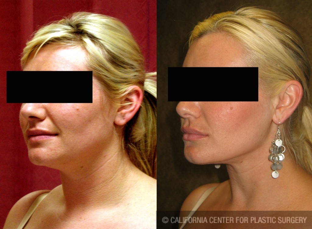 Neck & Face Liposuction Before & After Patient #6609