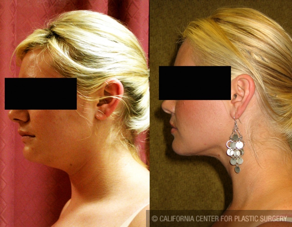 Neck & Face Liposuction Before & After Patient #6609