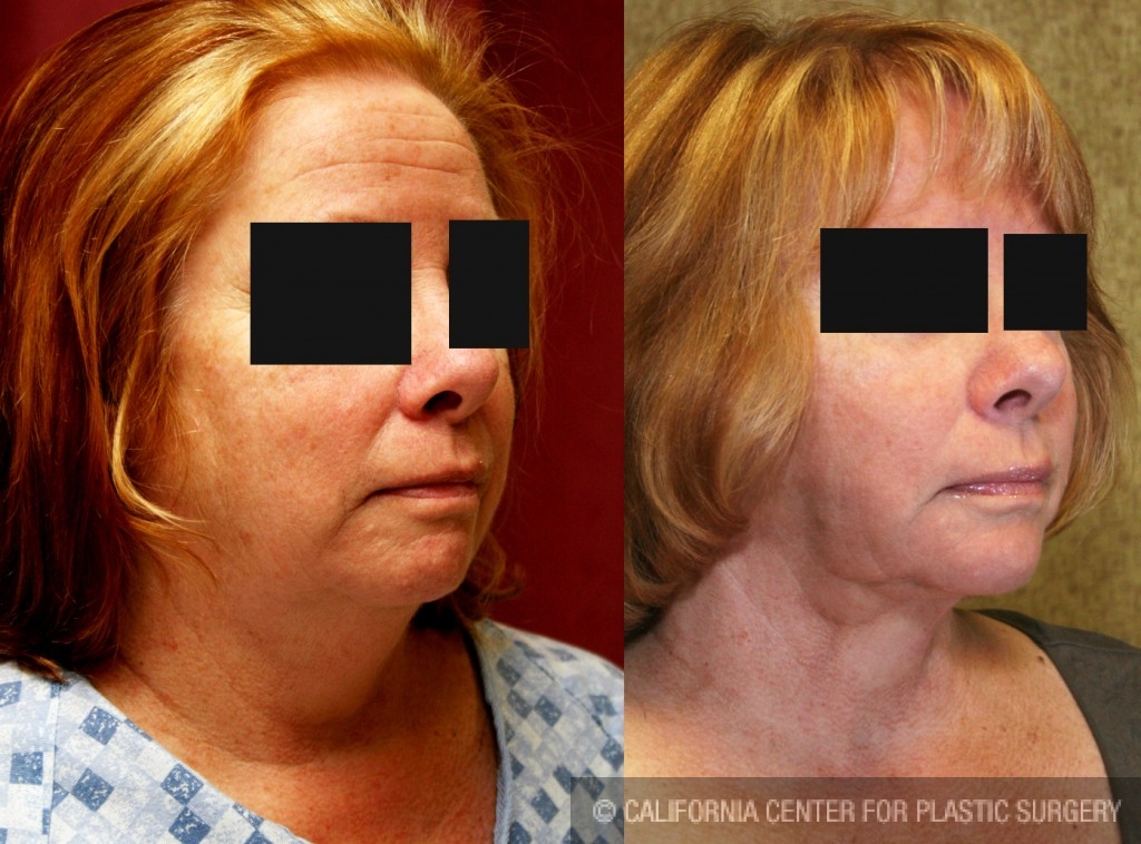 Neck & Face Liposuction Before & After Patient #6663