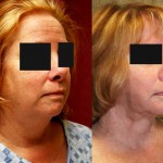 Neck & Face Liposuction Before & After Patient #6663
