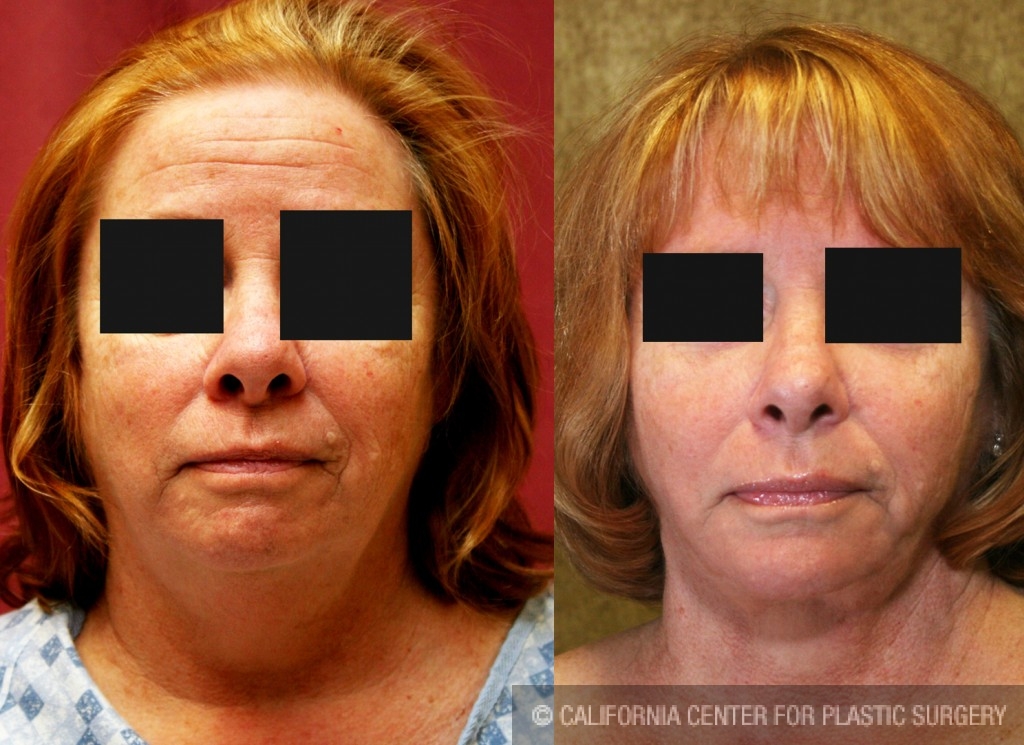 Neck & Face Liposuction Before & After Patient #6663