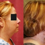 Neck & Face Liposuction Before & After Patient #6663