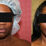 Neck & Face Liposuction Before & After Patient #6667