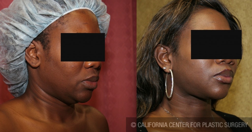 Neck & Face Liposuction Before & After Patient #6667