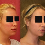 Neck & Face Liposuction Before & After Patient #6673