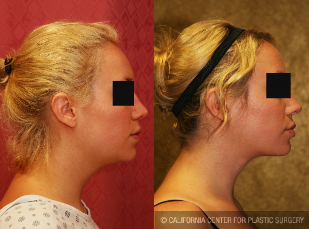 Neck & Face Liposuction Before & After Patient #6673