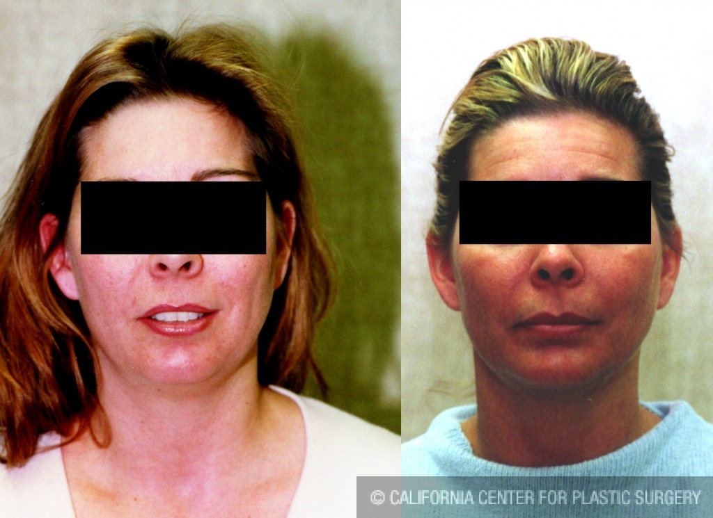 Neck & Face Liposuction Before & After Patient #6619