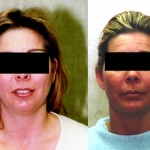 Neck & Face Liposuction Before & After Patient #6619