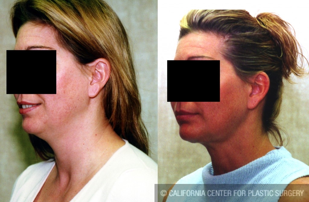 Neck & Face Liposuction Before & After Patient #6619