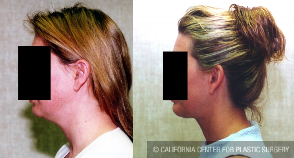 Neck & Face Liposuction Before & After Patient #6619