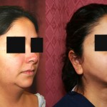 Neck & Face Liposuction Before & After Patient #6627