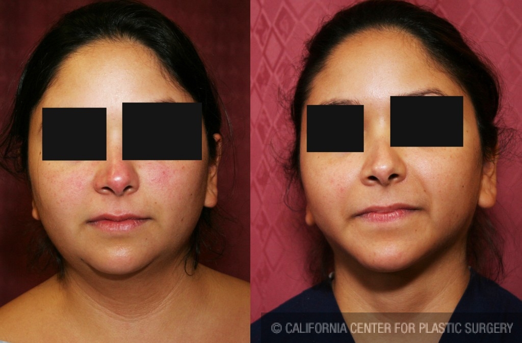 Neck & Face Liposuction Before & After Patient #6627