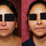 Neck & Face Liposuction Before & After Patient #6627