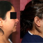 Neck & Face Liposuction Before & After Patient #6627