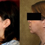 Neck & Face Liposuction Before & After Patient #6634