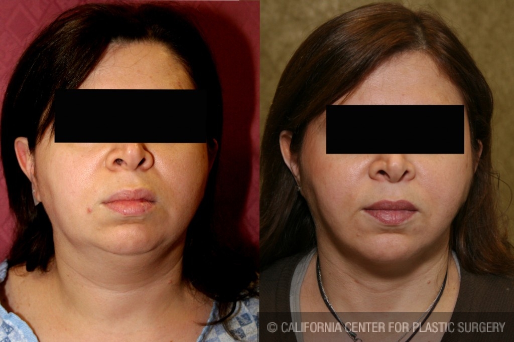 Neck & Face Liposuction Before & After Patient #6634