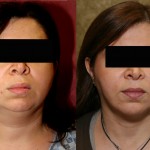 Neck & Face Liposuction Before & After Patient #6634