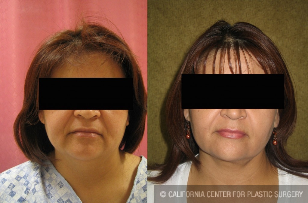 Neck & Face Liposuction Before & After Patient #6640