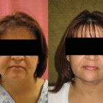 Neck & Face Liposuction Before & After Patient #6640