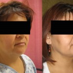 Neck & Face Liposuction Before & After Patient #6640