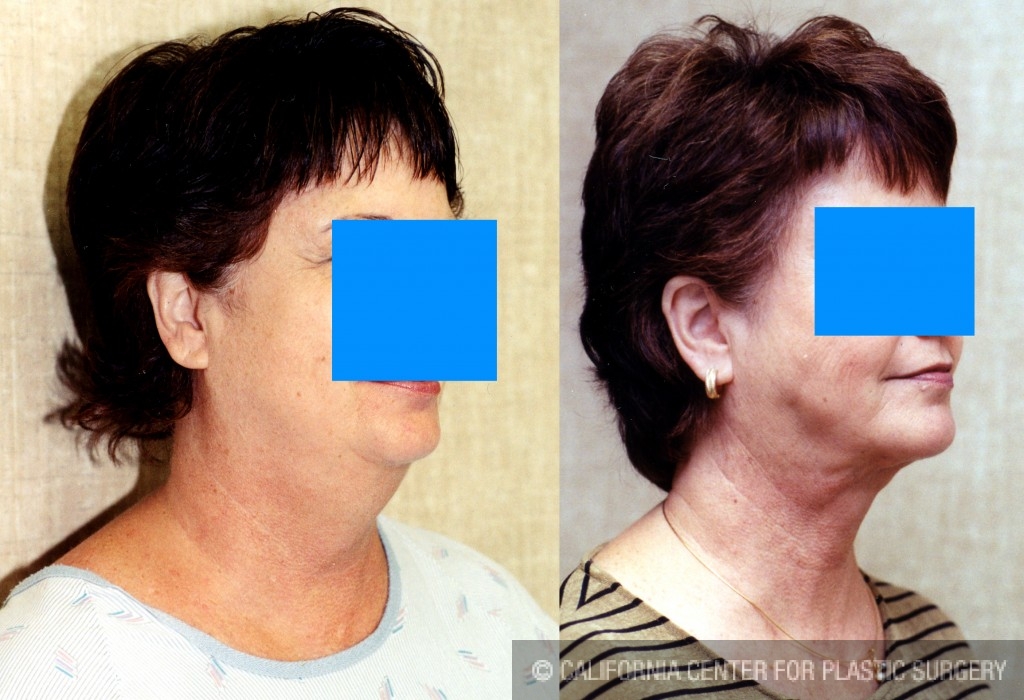 Neck & Face Liposuction Before & After Patient #6647