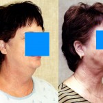 Neck & Face Liposuction Before & After Patient #6647