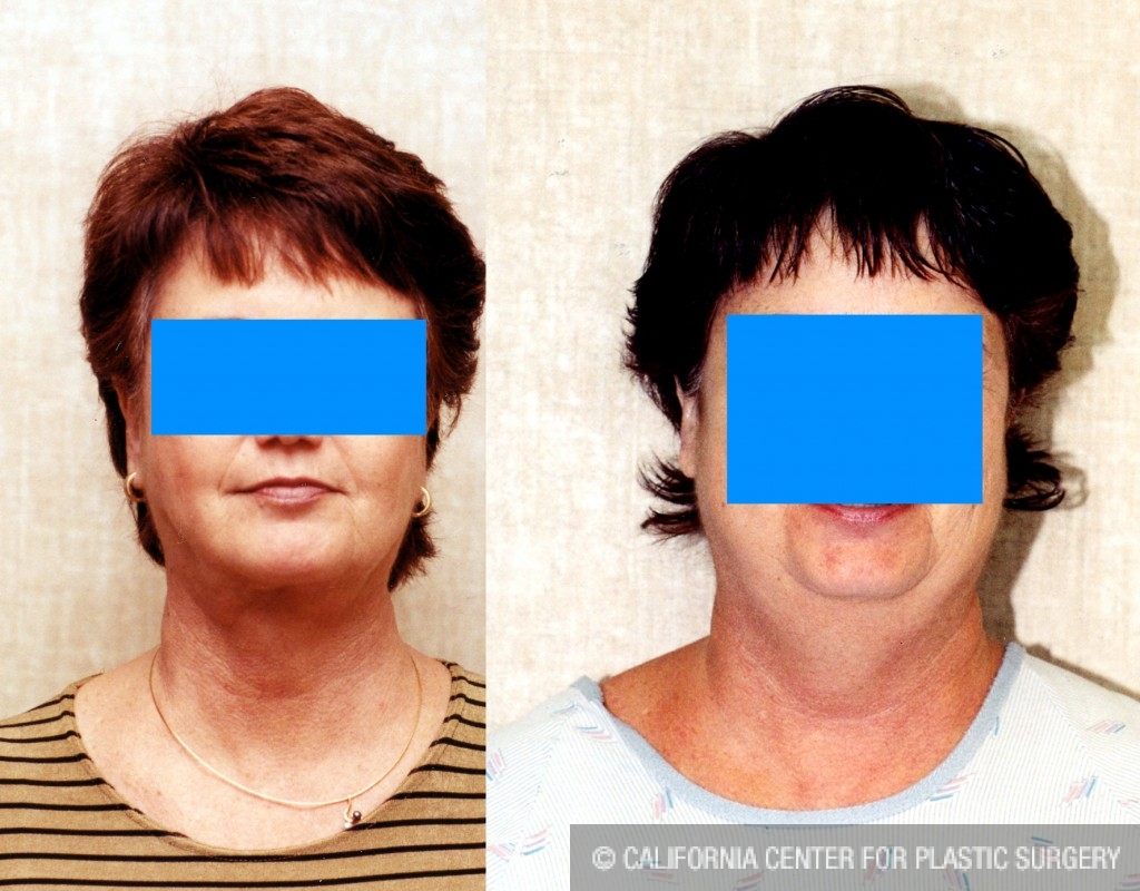 Neck & Face Liposuction Before & After Patient #6647