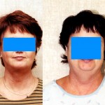 Neck & Face Liposuction Before & After Patient #6647