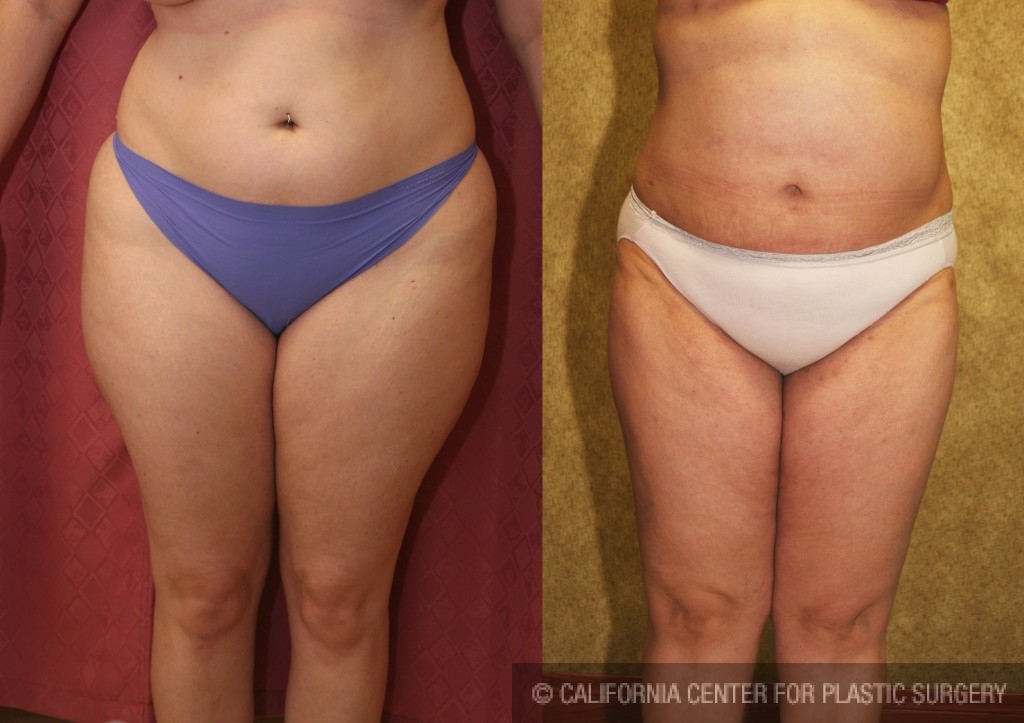 Liposuction Thighs Before & After Patient #6721