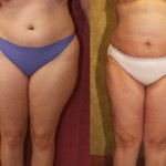 Liposuction Thighs Before & After Patient #6721