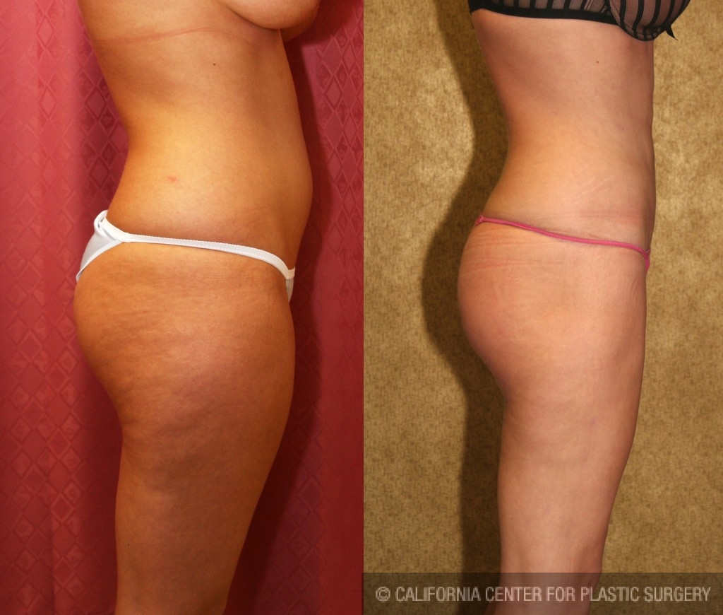 Liposuction Thighs Before & After Patient #6716