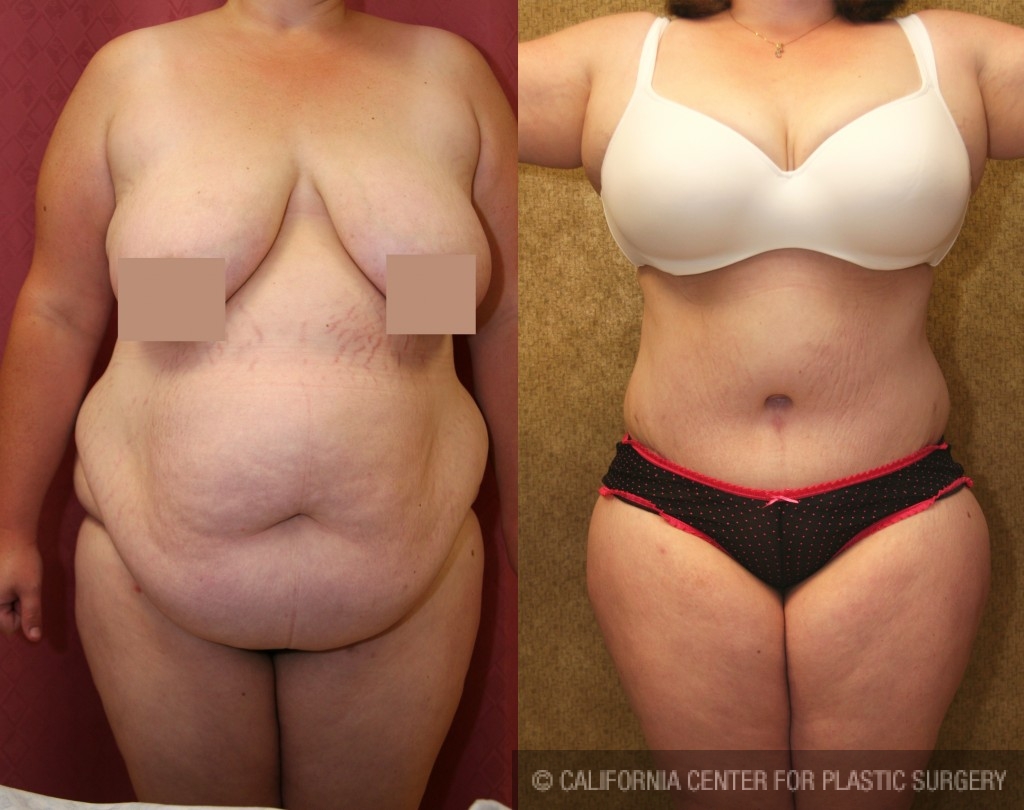 Tummy Tuck (Abdominoplasty) Plus Size Before & After Patient #5894