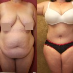Tummy Tuck (Abdominoplasty) Plus Size Before & After Patient #5894