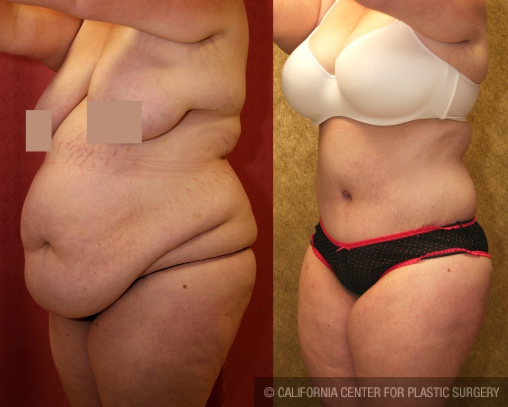 Tummy Tuck (Abdominoplasty) Plus Size Before & After Patient #5894
