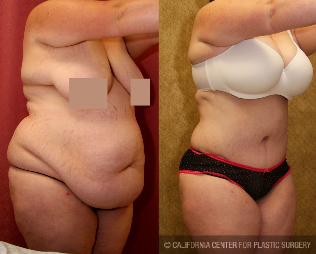 Tummy Tuck (Abdominoplasty) Plus Size Before & After Patient #5894