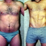 Male Liposuction Abdomen Before & After Patient #5609