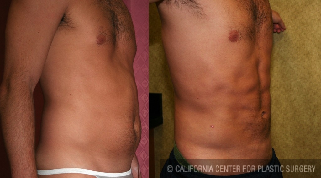 Male Liposuction Abdomen Before & After Patient #5614