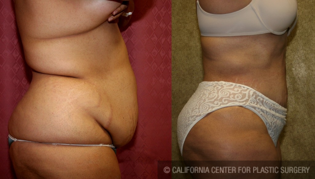 Liposuction Abdomen Plus Size Before & After Patient #5580